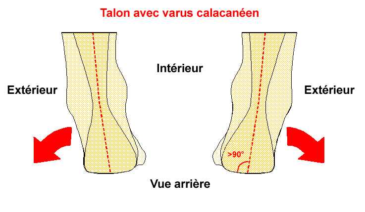 Pathologies Varus calcan en